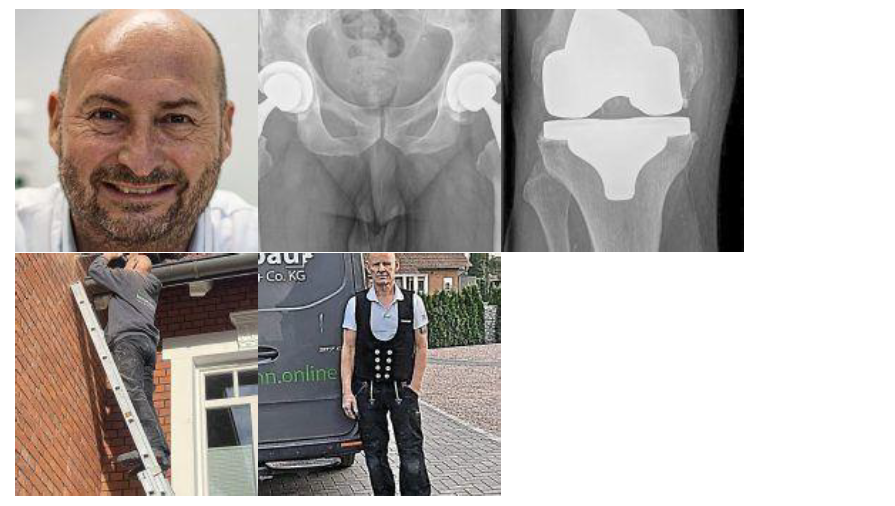 2026-03-11 15_56_01-2026_03_11_OVB online_Zwei Operationen vier neue Gelenke.pdf - Adobe Acrobat Rea