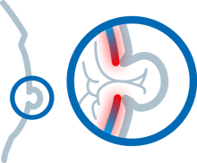 khws_web_medizin_illu_nabelbruch
